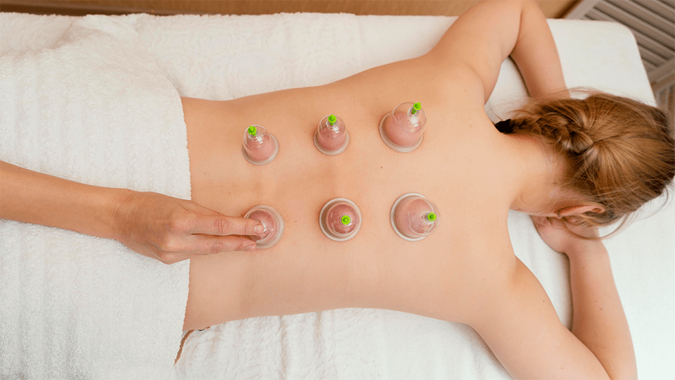 cupping therapy