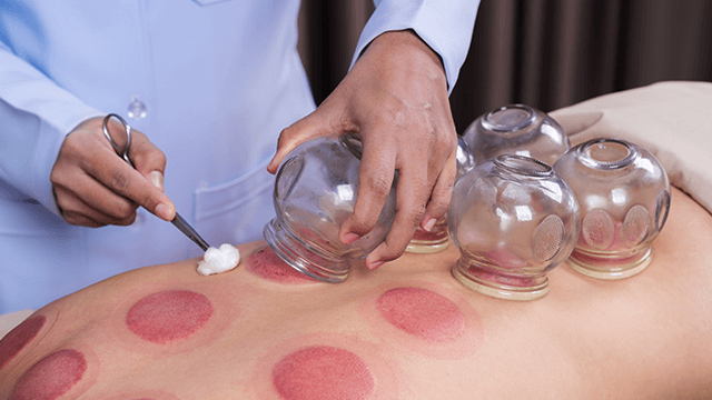 Hijama cupping therapy