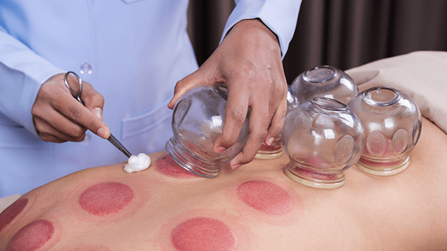 Cupping Therapy