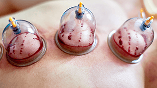 Hijama cupping therapy