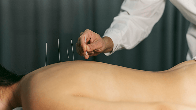 dry needling therapy