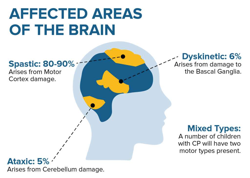 affected areas of brain 