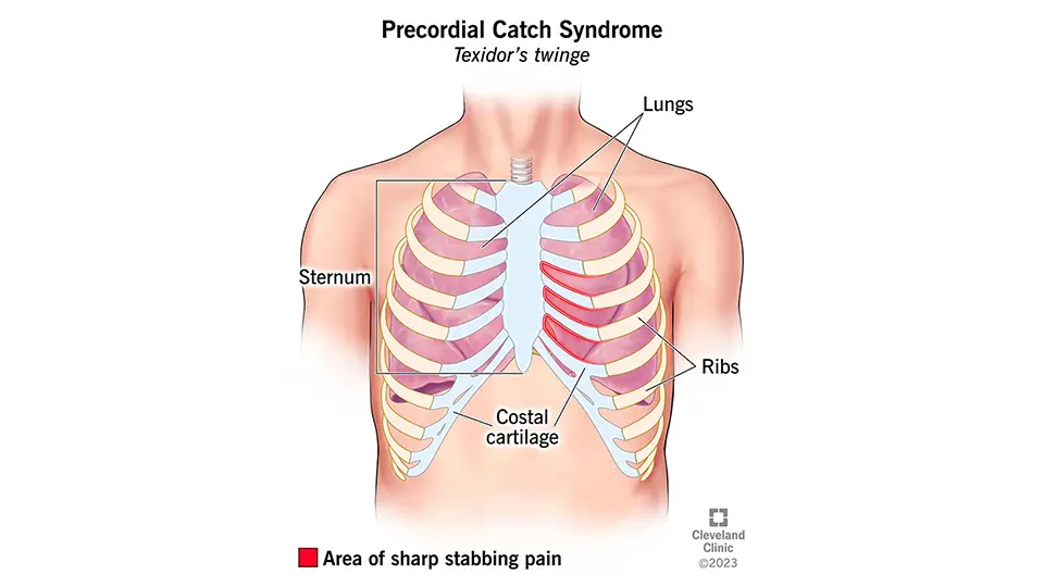 Understanding Precordial Catch Syndrome Why That Sharp Chest Pain Isn't Your Heart